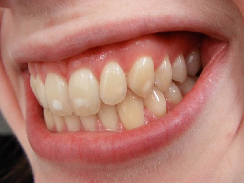 Причины деминерализации зубов
