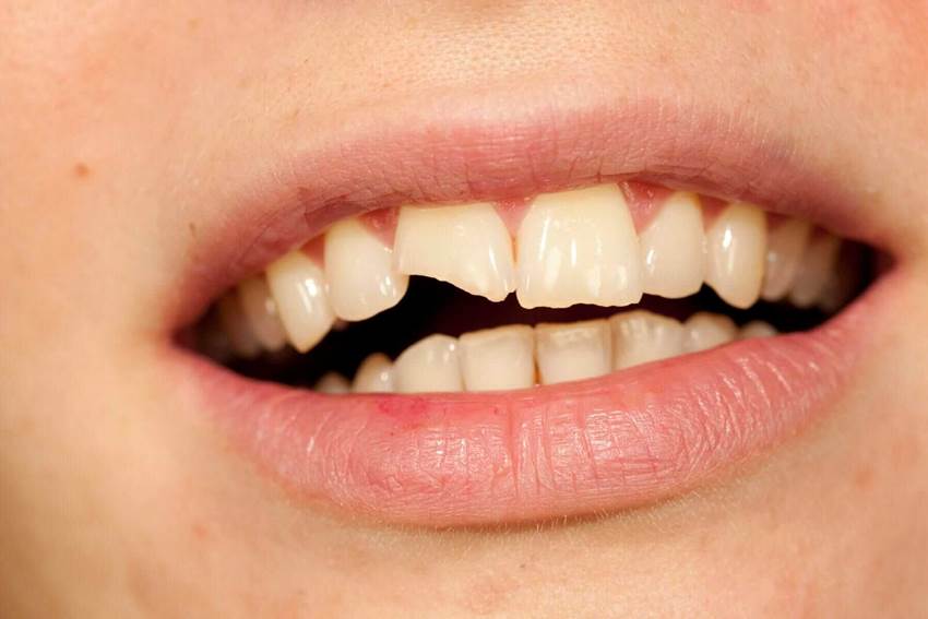 Что такое скол зуба