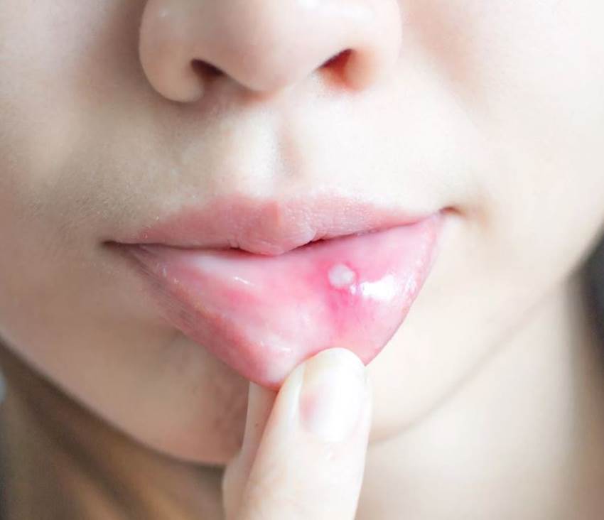 Как развивается стоматит в полости рта