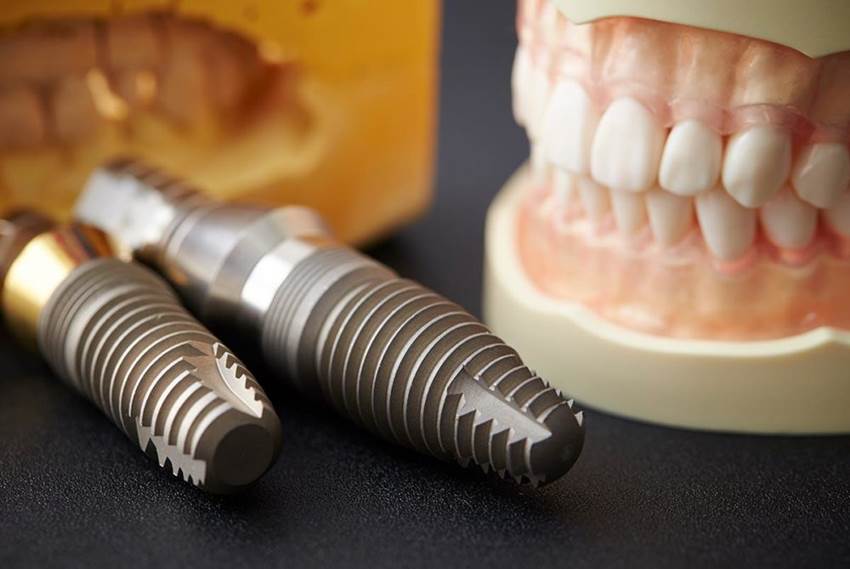 Виды и особенности зубных имплантов