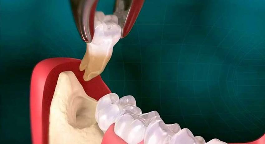Что такое альвеолит после удаления зуба