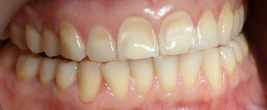 Способы восстановить естественный цвет зубов