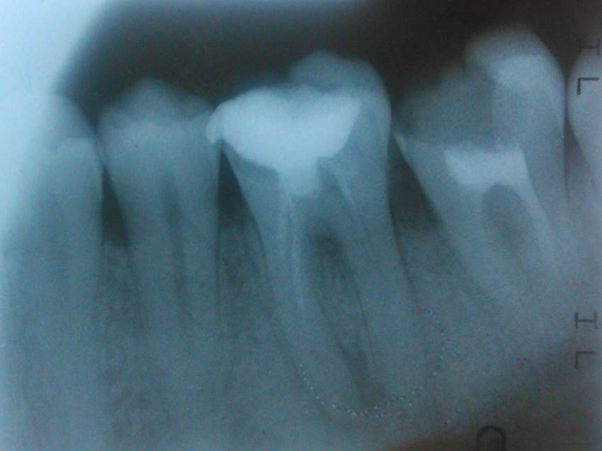 Сложности лечения зуба «шестерки»