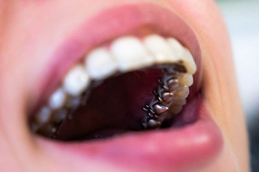 Виды брекетов по типу расположения на зубах