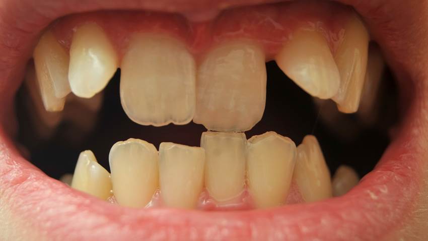 Разновидности скола зуба