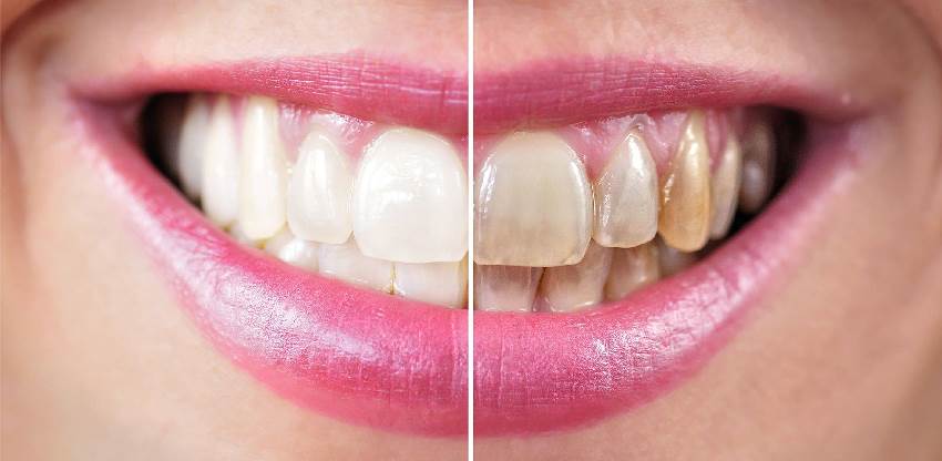 Как бороться с коричневыми отложениями на зубах