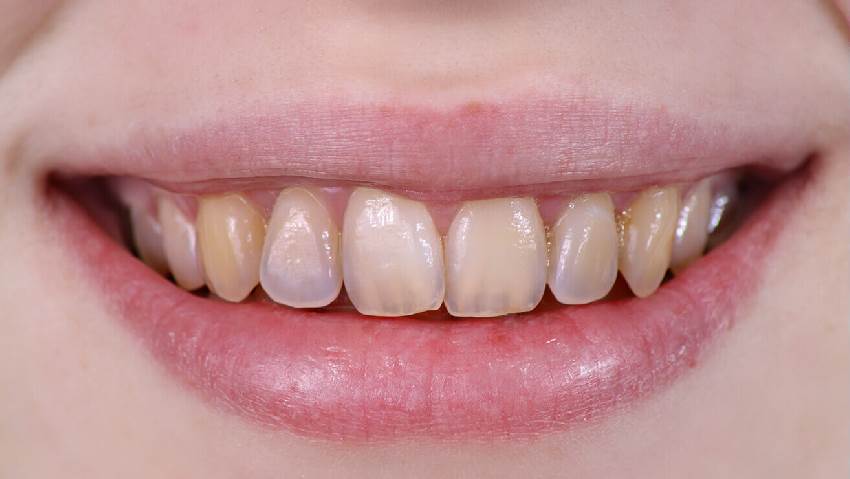 Что значит деминерализации зубов