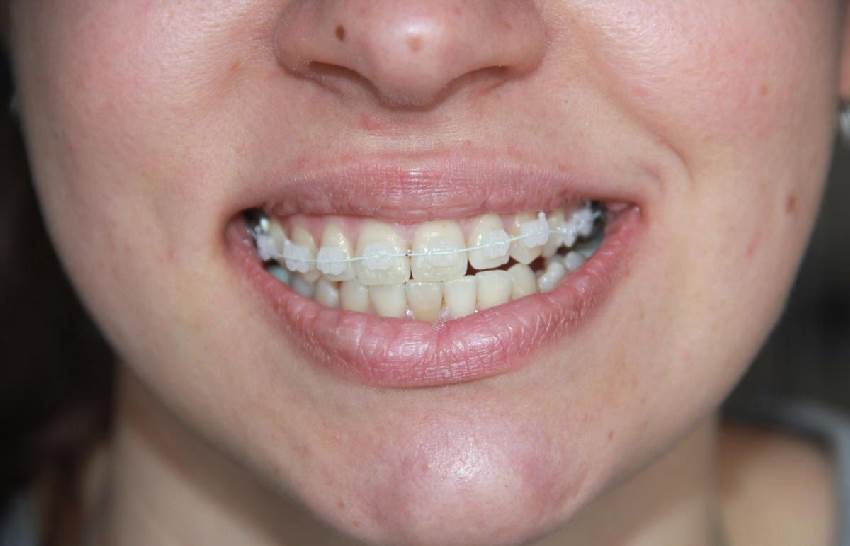 Влияние открытого прикуса на здоровье зубов и общее состояние