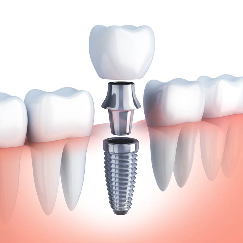 Имплантация зуба «шестерки» сверху и снизу