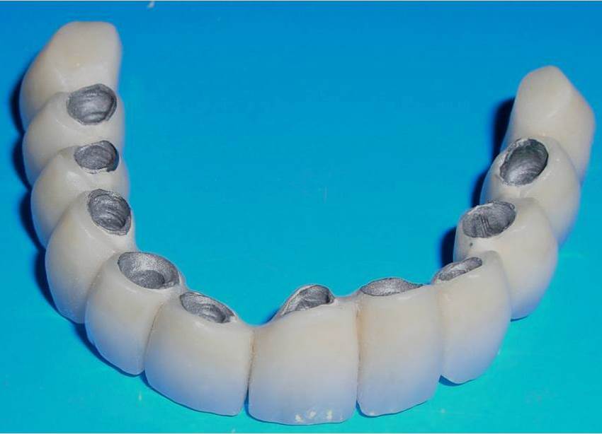 Виды металлокерамических зубов