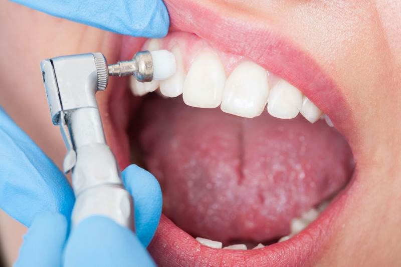 Процедура полировки зубов