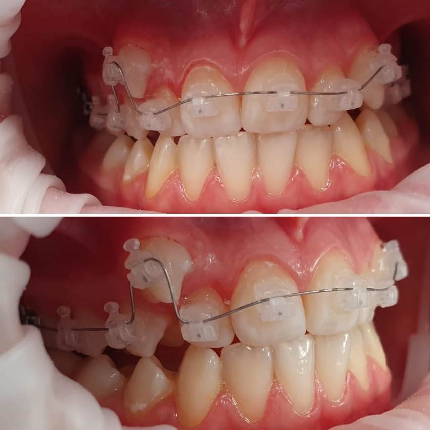 Диагностика и лечение дистопированного зуба