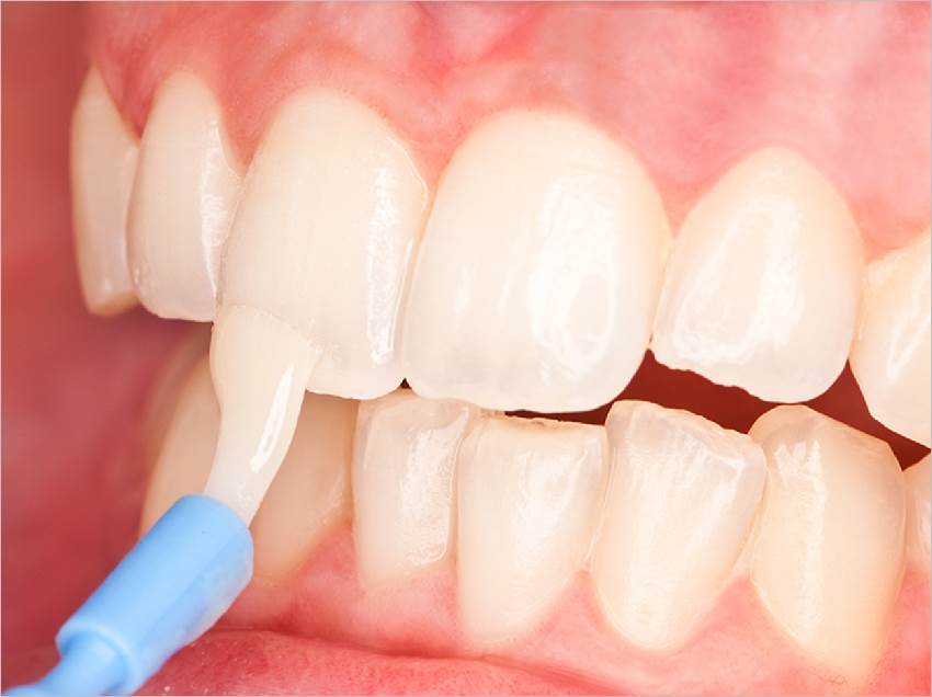 Фторирование при деминерализации зубов