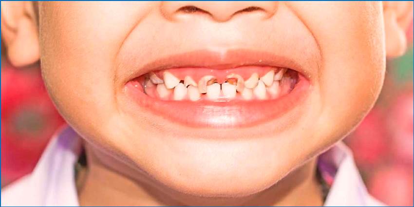 Признаки деминерализации зубов