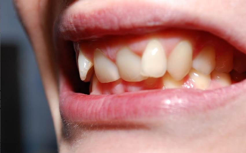 Аномалии положения зубных единиц