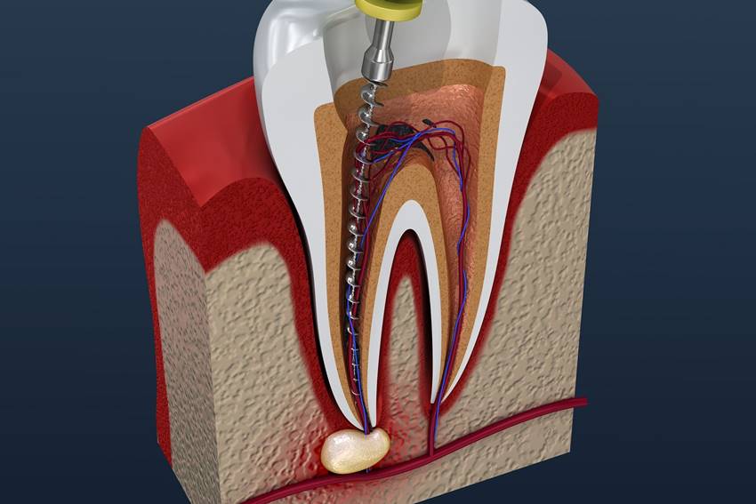 Что такое зуб без нерва и как он выглядит