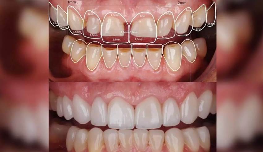 Общая характеристика патологической стираемости зубов