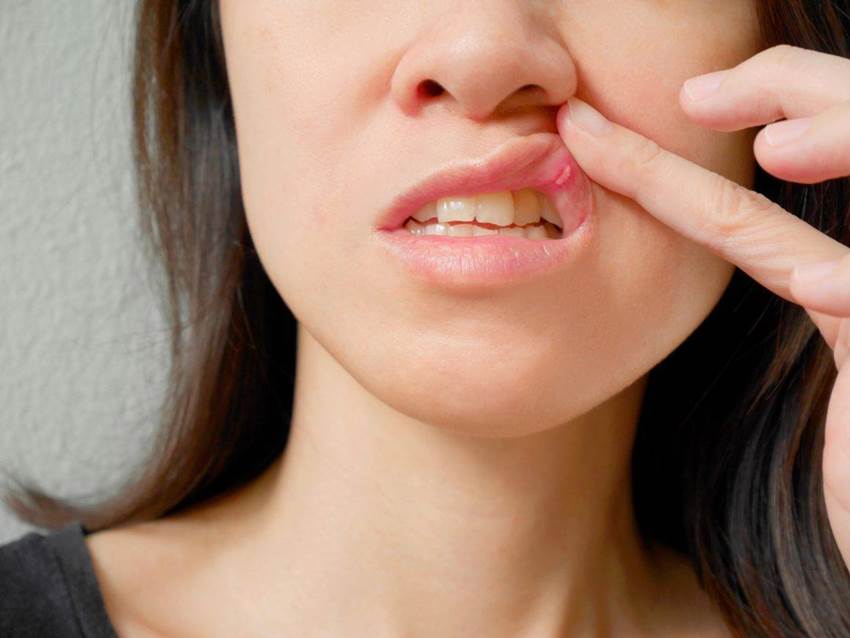 Соединительнотканные опухоли – шишки во рту на нёбе, щеке, десне и языке
