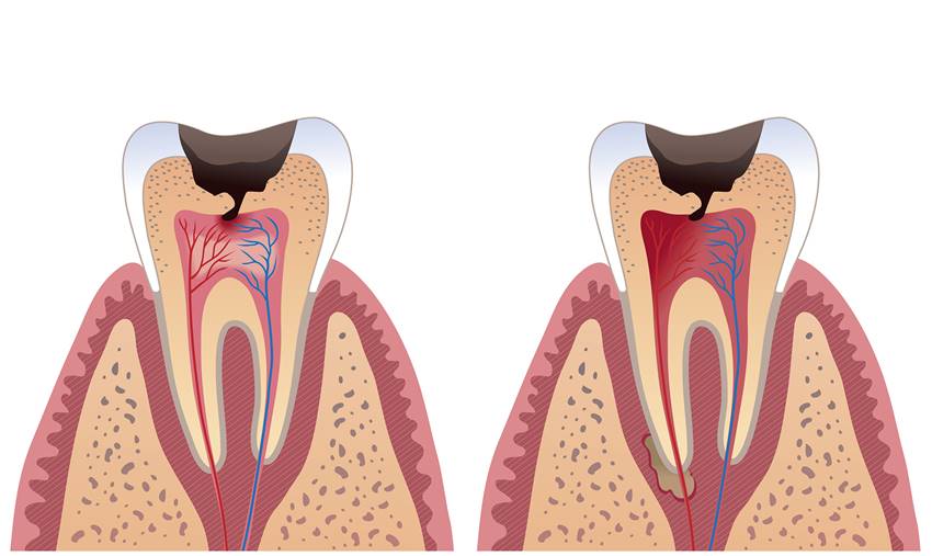 Основные причины потемнения зуба