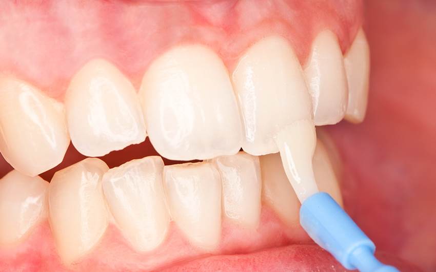 Методы лечения клиновидного дефекта зубов