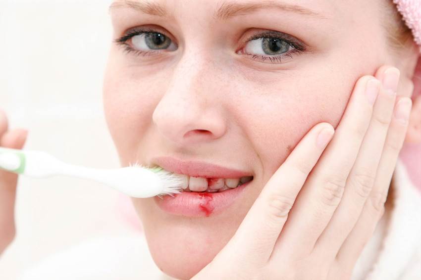 Как остановить кровь после удаления зуба в домашних условиях