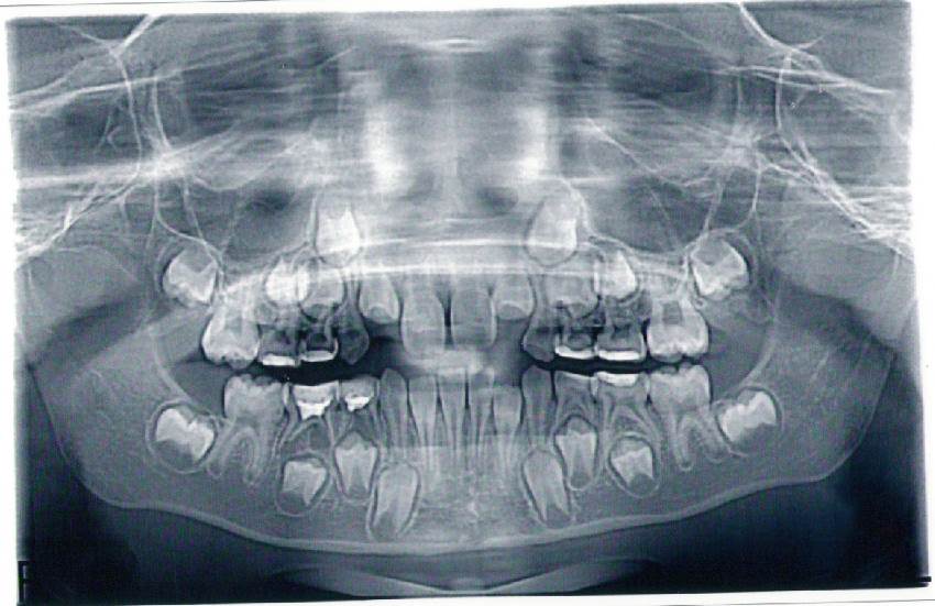Последовательность появления зубов у детей
