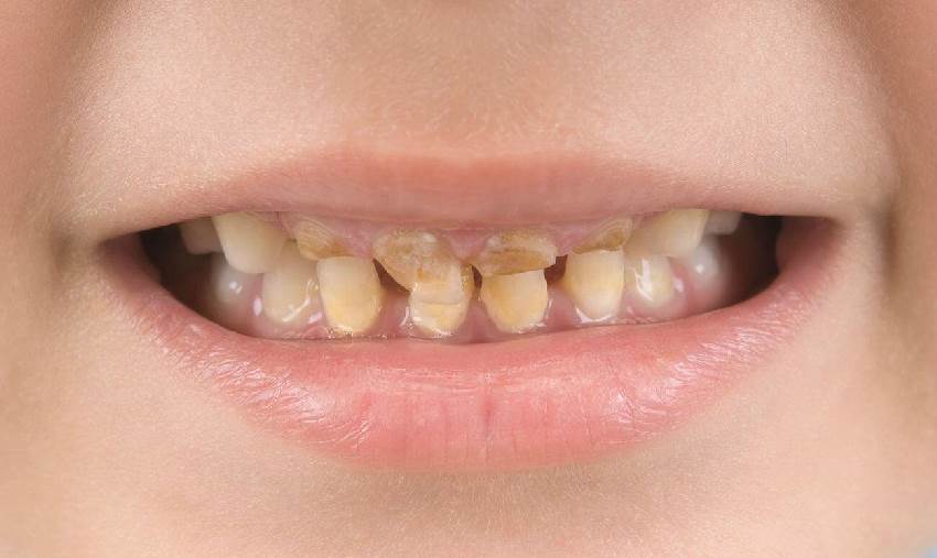 Причины коричневых зубов у детей