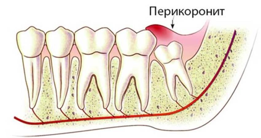 10 причин острой зубной боли