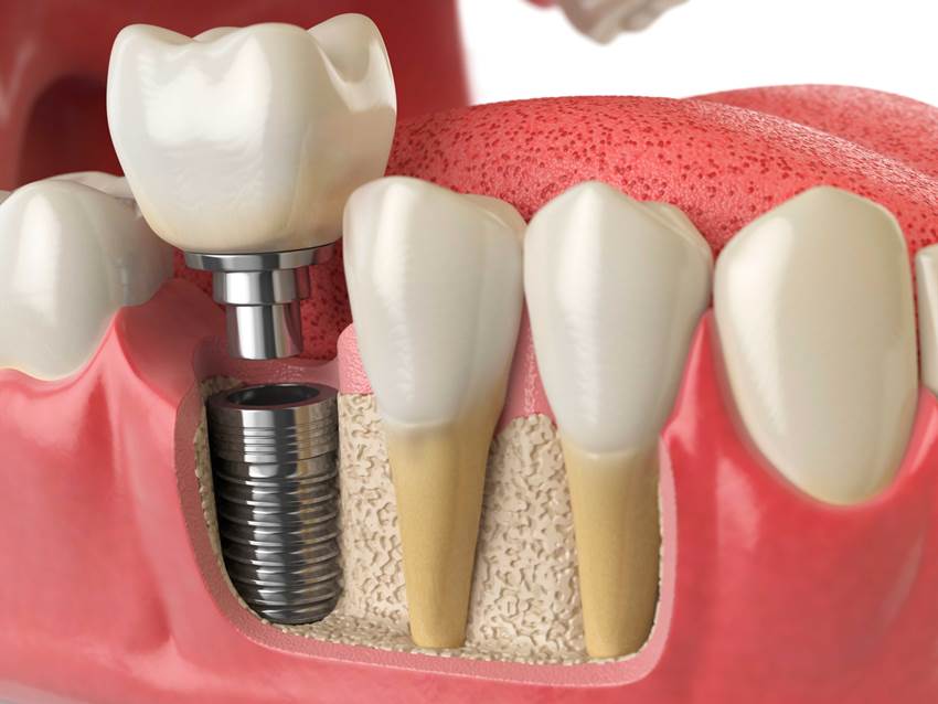 Что собой представляют зубные импланты