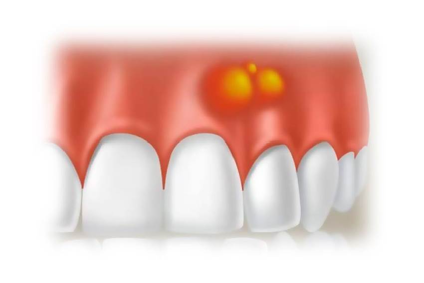 Киста зуба – причины, симптомы, последствия