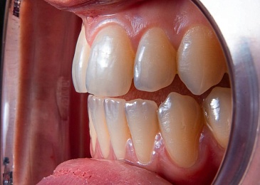 Полировка зубов: показания, противопоказания, процедура