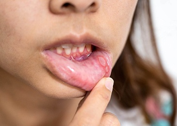 Прыщ во рту: симптомы, причины, профилактика