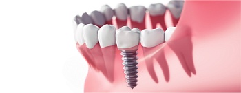 Имплант зуба под ключ: что входит в стоимость работы?