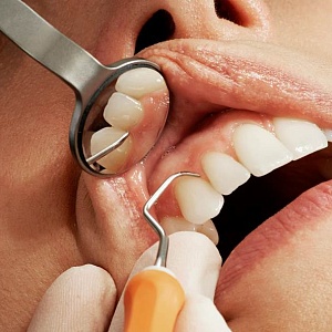 Потемнел зуб: причины, диагностика, методы лечения