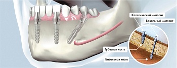 Базальная имплантация зубов: благо или зло?