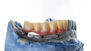 Отсутствие нижних зубов: последствия и способы лечения