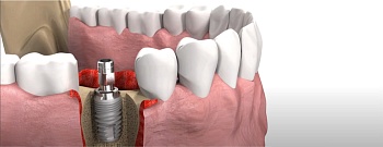 Установка импланта зуба : как, кому и зачем?