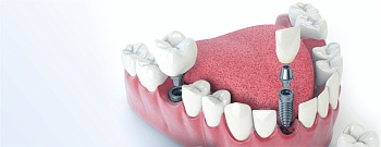 Имплантация нижних зубов: специфика и особенности