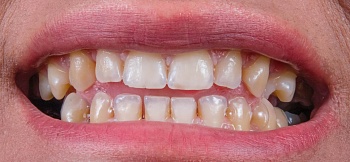 Коричневые зубы: причины и лечение