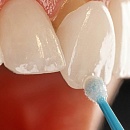 Деминерализация зубов: причины, признаки, лечение