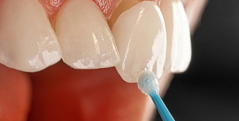 Деминерализация зубов: причины, признаки, лечение