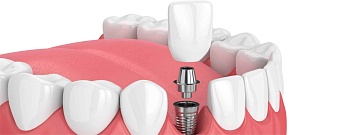 Коронки на зубные импланты: как сделать правильный выбор?