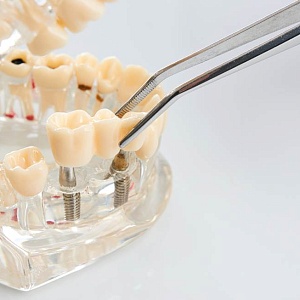 Одномоментная имплантация зубов: быстрое и эффективное восстановление улыбки