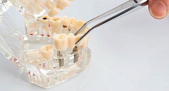 Одномоментная имплантация зубов: быстрое и эффективное восстановление улыбки