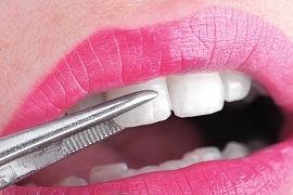 Что такое виниры для зубов: виды, преимущества и способы установки