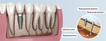 Дентальная имплантация зубов: в чем суть методики?