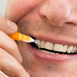 Как удалить зубной камень: методы лечения и профилактики