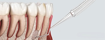 Резекция верхушки корня. Хирургический способ сохранить зуб