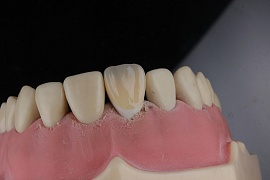Клиновидный дефект зубов: причины, методы лечения