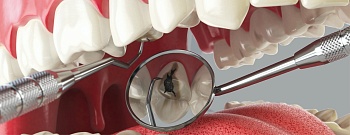 Классификация кариеса. Как стоматологи выбирают технику лечения